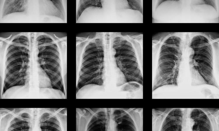 Inteligencia artificial podría facilitar el uso de radiografías de pecho para diagnosticar COVID-19